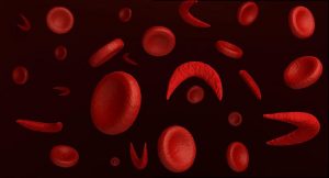 sickel-cell