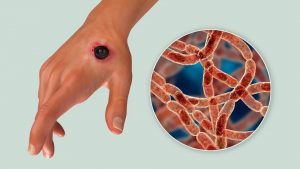 Nigeria confirms first anthrax disease case